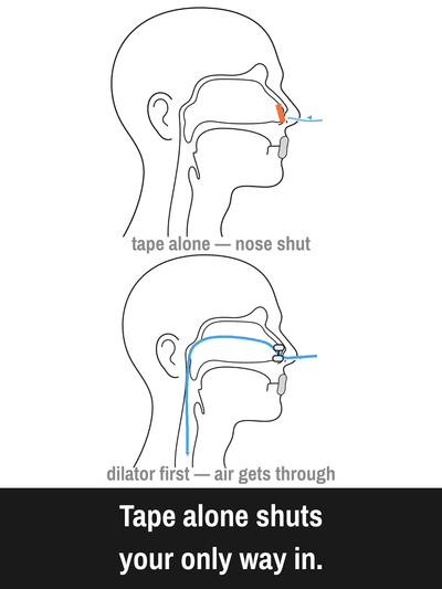 Zephyrra™ Nasal Dilator