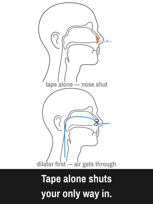 Zephyrra™ Nasal Dilator